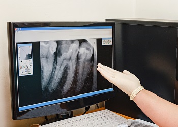 A dental professional pointing to an X-Ray image on the computer screen