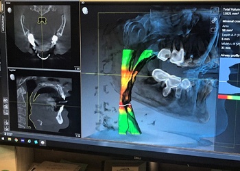 The X-Ray image captured with the Sirona Orthophos CBCT Airway Imaging device