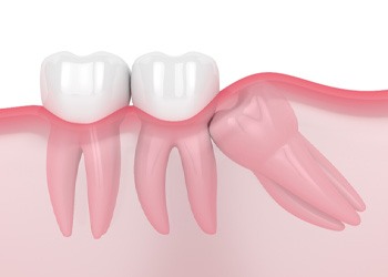 impacted tooth illustration for cost of tooth extraction Powell