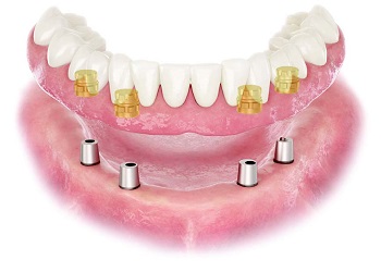 Animation of conus denture placement