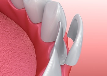 Animation of porcelain veneer placement