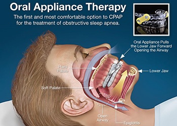 A drawing of a patient lying down and a cross-section of their mouth and how an oral appliance is helping to open their airway and improve their breathing