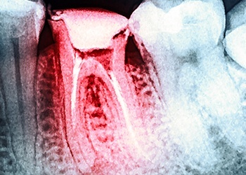 Dental x-ray with damaged tooth highlighted red