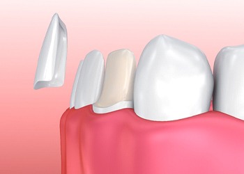 A porcelain veneers